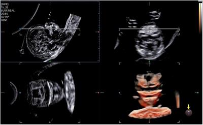 Cleft palate in fetuses: feasibility of early diagnosis by Crystal and Realistic Vue rendering 3D ultrasound technology in the first trimester